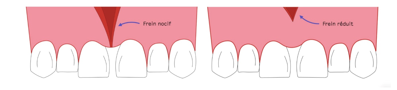 frenectomie